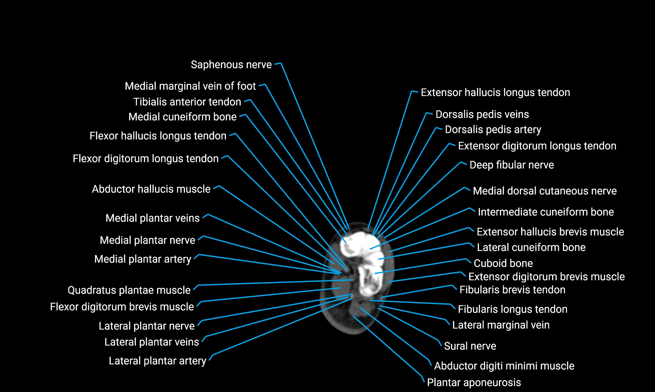 CT lower limb axial cross sectional anatomy labelled image 178 (2).webp
